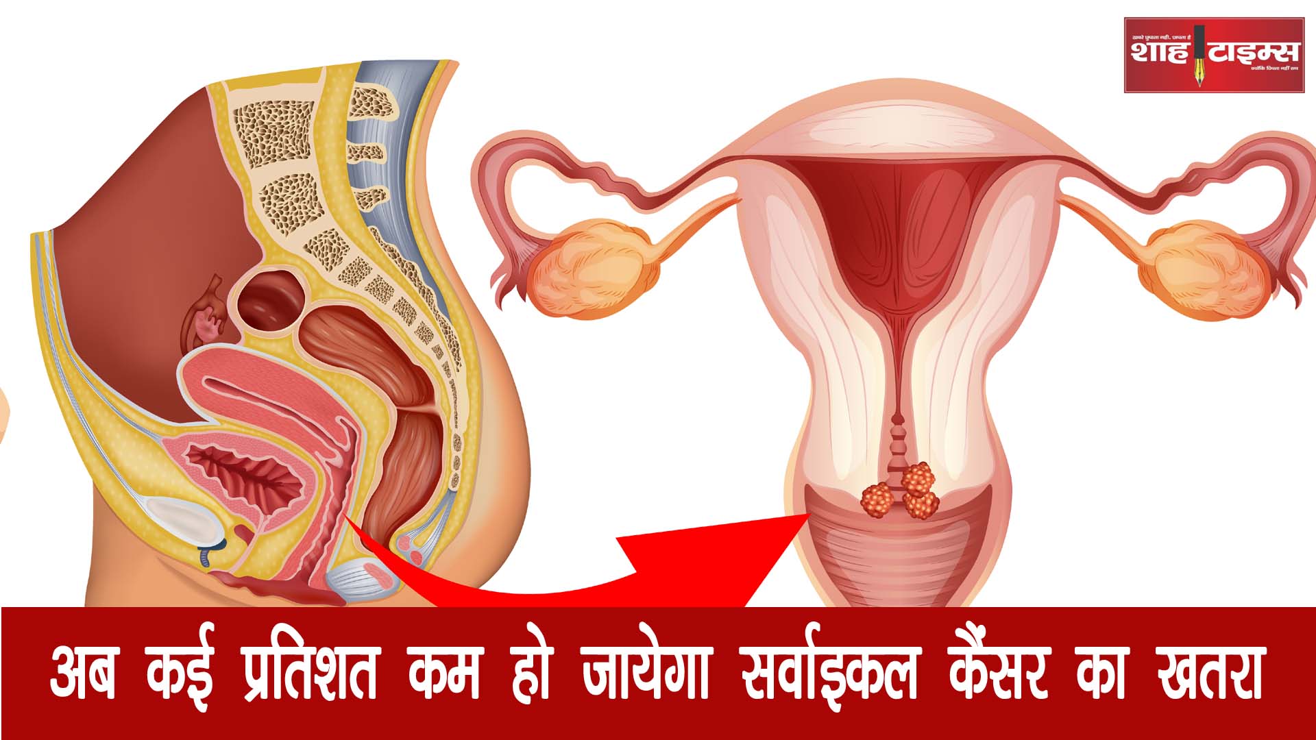cervical cancer